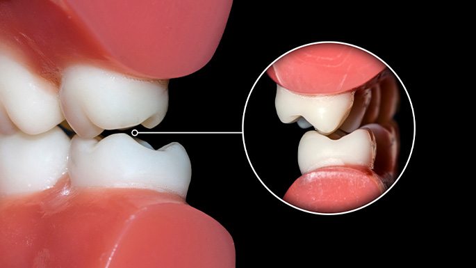 A model of two rows of teeth grinding against each other to demonstrate bruxism