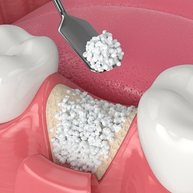 Illustration of bone graft being performed between natural teeth