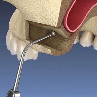 Illustration of instrument being used to lift the sinus membrane