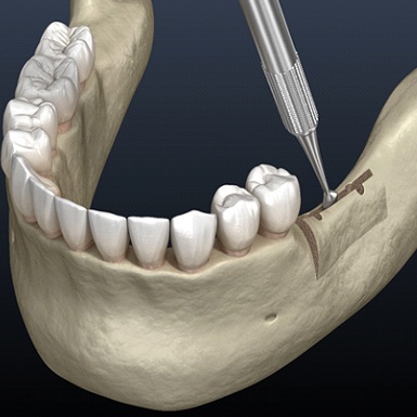 Illustration of alveolar ridge expansion/ridge augmentation procedure for lower jaw
