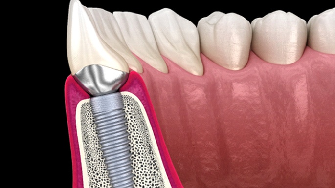 Side view of traditional dental implant in jawbone