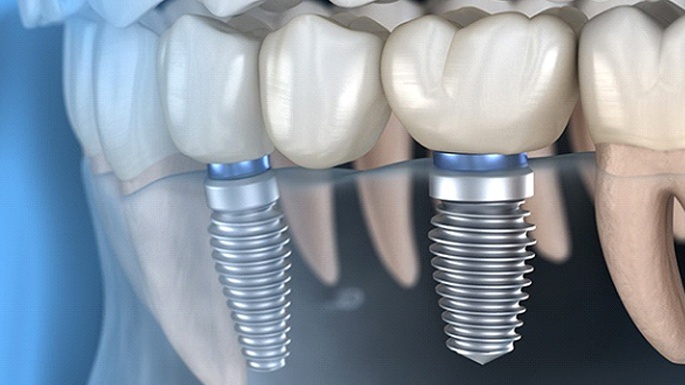 Animated smile with dental implant supported fixed bridge