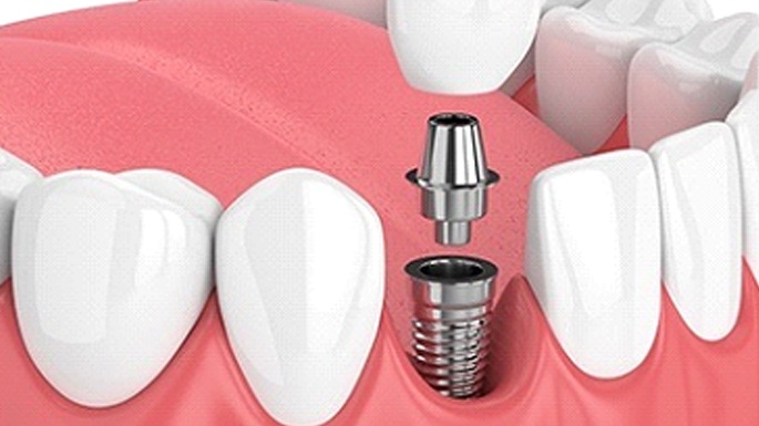dental implant being placed in the lower jaw