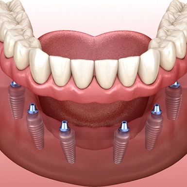 diagram showing implant dentures