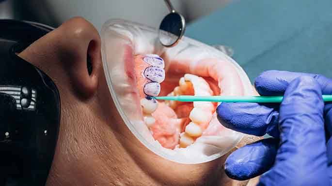 Fluoride treatment is applied directly to your teeth and takes just minutes.