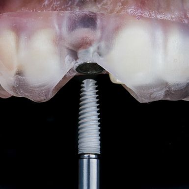 Dental implant being placed in jawbone against dark background