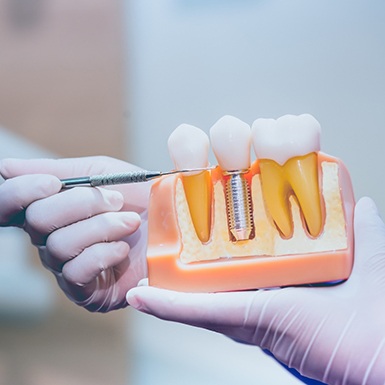 Gloved hand holding model, explaining dental implant parts