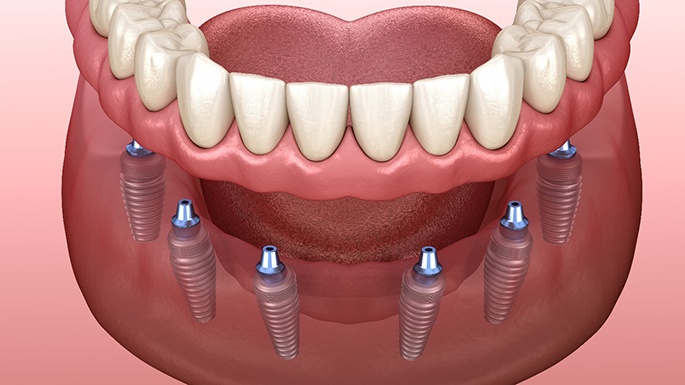 diagram of implant dentures in Philadelphia