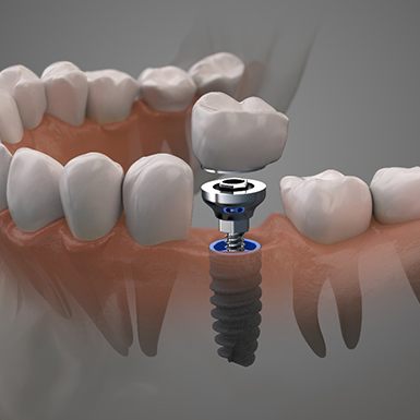 Single dental implant in Philadelphia