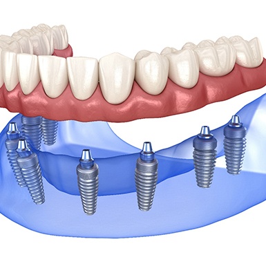 Implant denture in Philadelphia