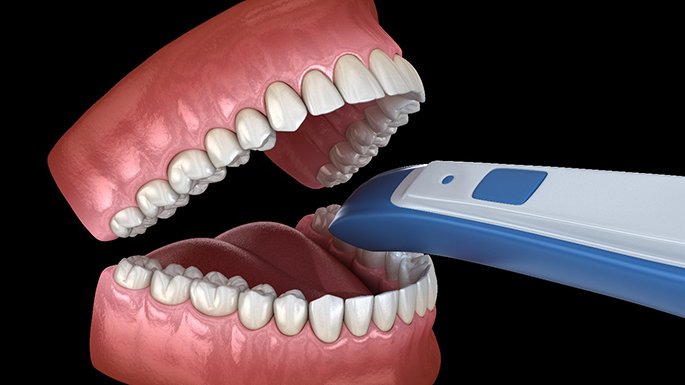 Illustration of intraoral camera being used to record images of teeth