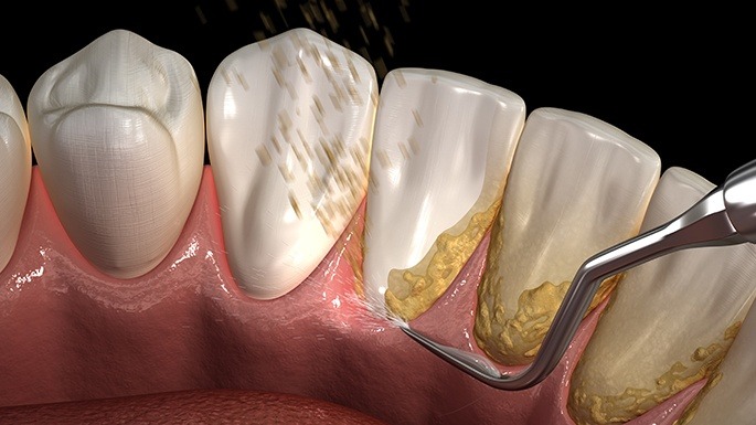 Animated smile during scaling and root planing periodontal therapy