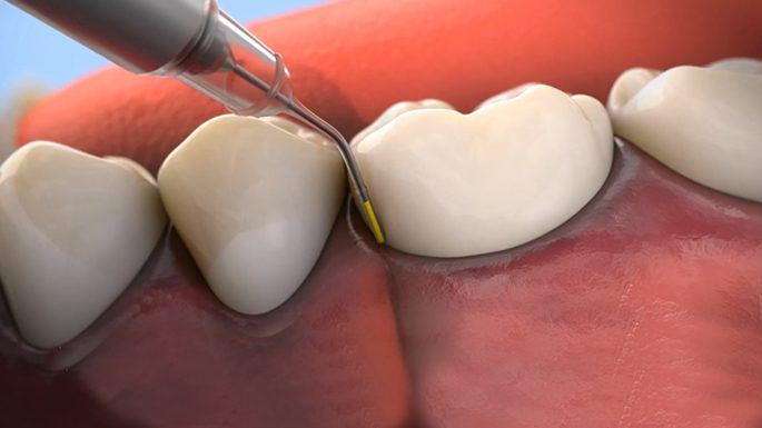 Animated smile during Arestin antibiotic therapy