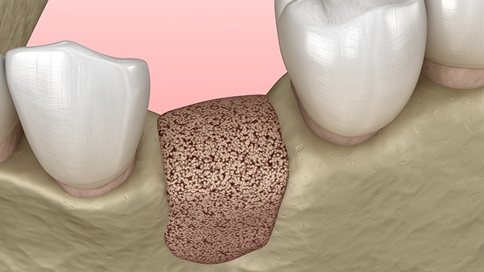 Animated smile after bone regeneration surgery