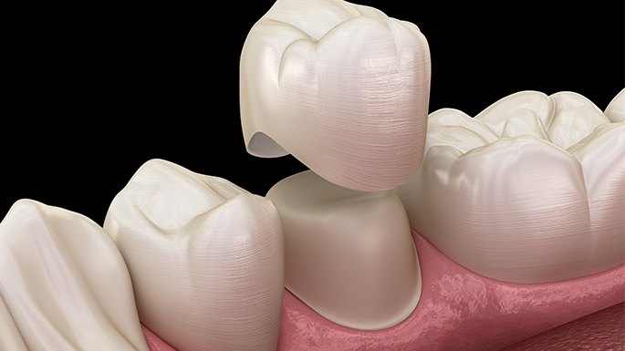 Animated smile during dental crown placement