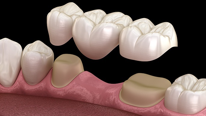 Animated smile during dental bridge treatment