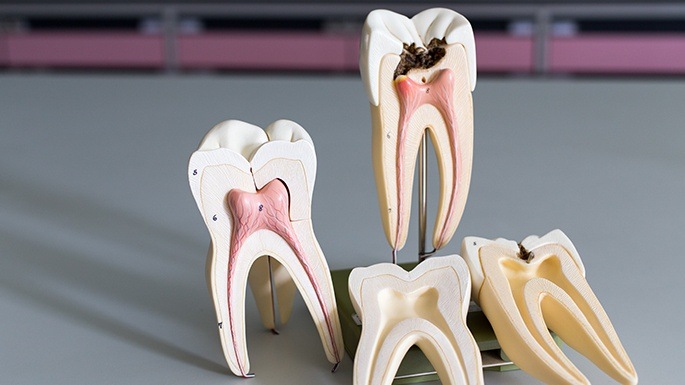 Models of the inside of a healthy tooth and a tooth in need of root canal therapy