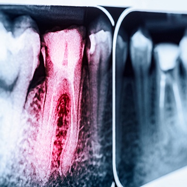 Red tooth on a dental x-ray