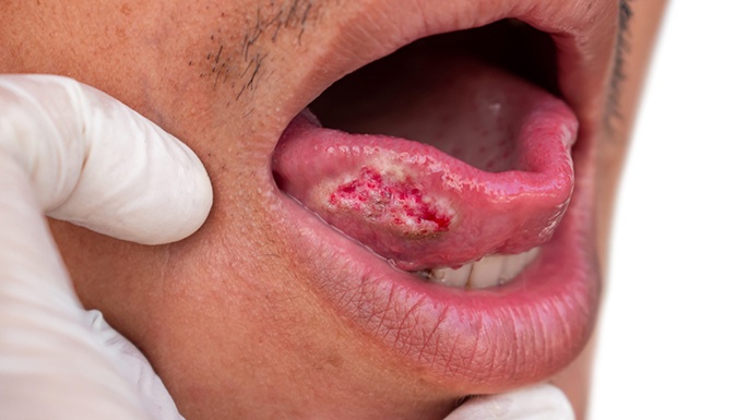 Closeup of mouth lesion