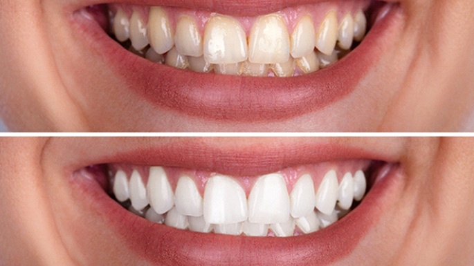 Before and after image of teeth whitening in Philadelphia