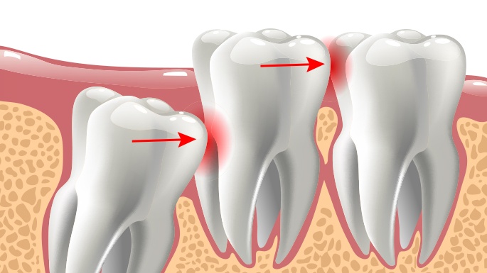 Animated smile with impacted wisdom tooth before extraction