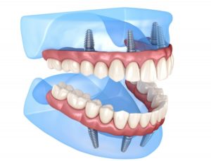 3D illustration of all-on-4 dental implants 