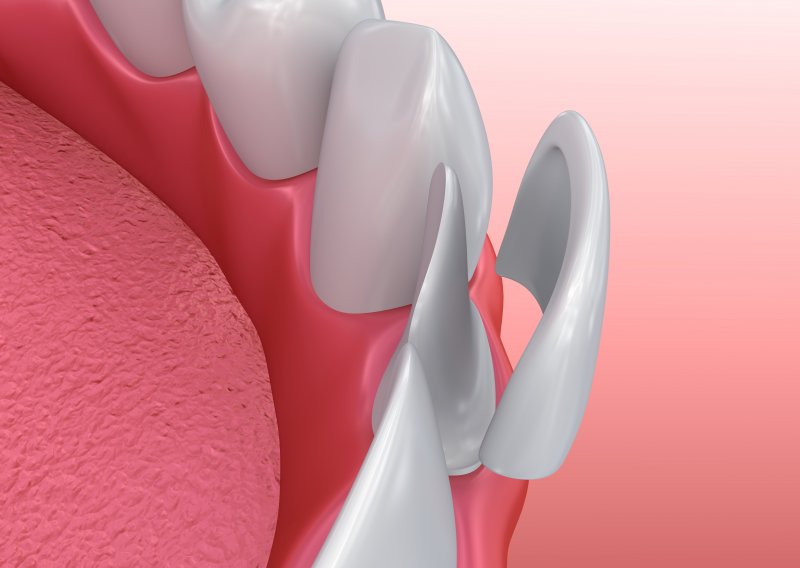 3-D Diagram of a veneer coming off of a tooth